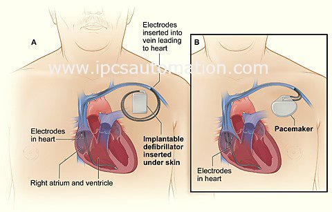  Implantable Cardioverter Defribrillators in IPCS